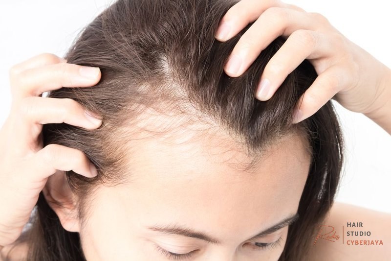 Female Hair Loss and PCOS - Chicago, IL Female Hair Loss and PCOS - Chicago, IL