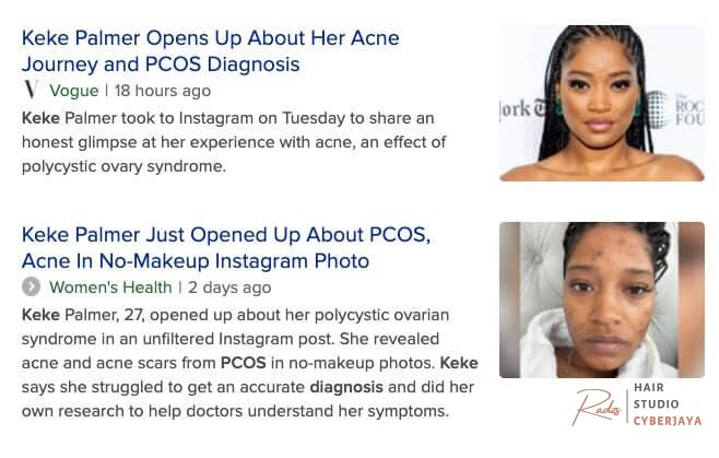 How to Avoid and Treat PCOS Hair Loss - Bauman Medical How to Avoid and Treat PCOS Hair Loss - Bauman Medical