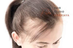 Managing PCOS Associated Hair Loss – Vancouver Naturopath Managing PCOS Associated Hair Loss – Vancouver Naturopath