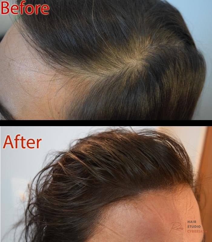 PCOS and Women Hair Loss: The Science Behind Shedding - DermiMatch Hair Clinic | Scalp Micropigmentation Phoenix, Arizona PCOS and Women Hair Loss: The Science Behind Shedding - DermiMatch Hair Clinic | Scalp Micropigmentation Phoenix, Arizona