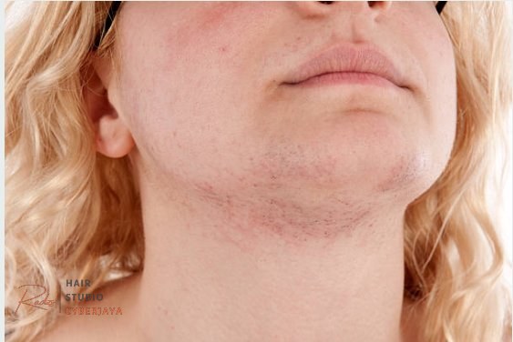 Electrolysis for PMOS, PCOS, Menopause, excess body hair, facial hair, chin hair, upper lip hair, PCOD | Electrolysis permanent hair removal Nanaimo, Parksville, Ladysmith, BC Electrolysis offers permanent solution for polycystic ovaries hair on chin