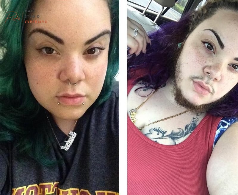 Women With PCOS Explain Why They Celebrate Their Facial Hair | Allure Women With PCOS Explain Why They Celebrate Their Facial Hair | Allure