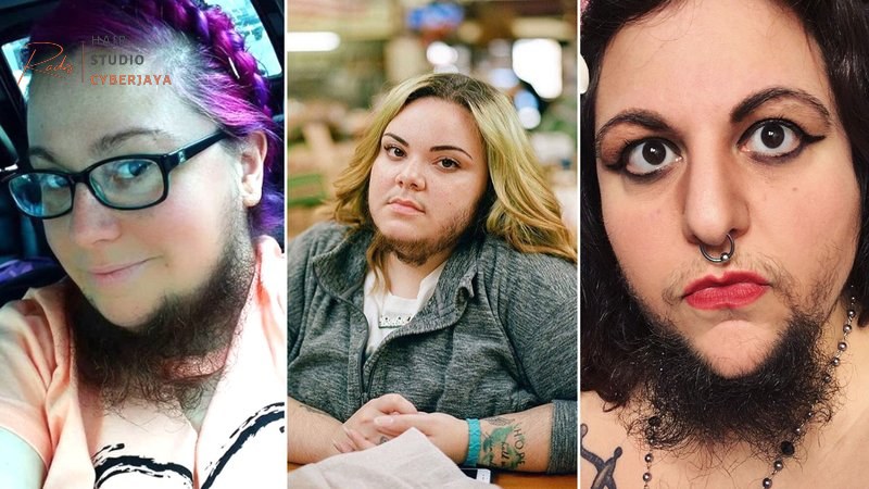 Women With PCOS Explain Why They Celebrate Their Facial Hair | Allure Women With PCOS Explain Why They Celebrate Their Facial Hair | Allure