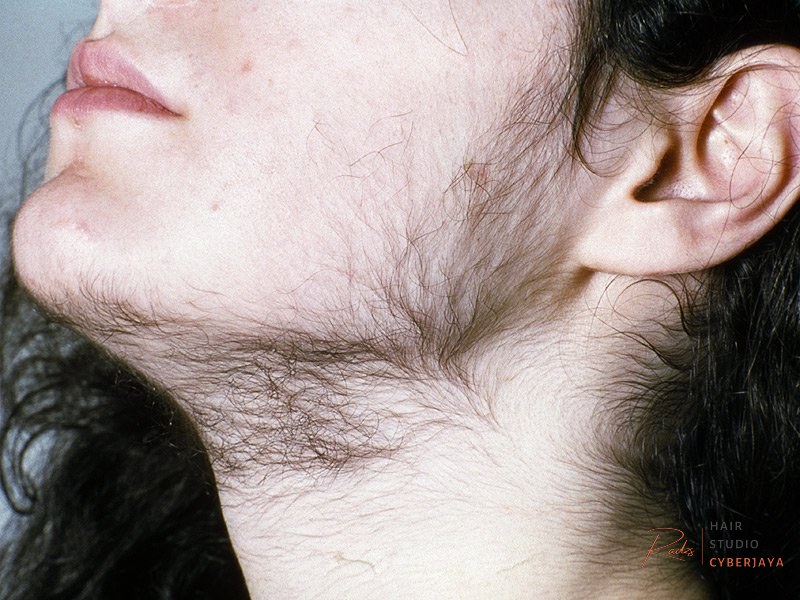 Hirsutism in Polycystic Ovary Syndrome Hirsutism is a common symptom for women with polycystic ovaries facial hair