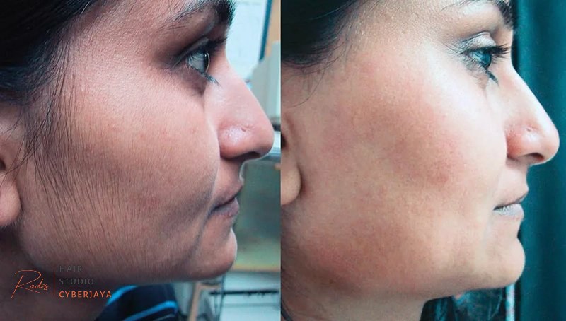 Permanent hair removal options for women with PCOS Laser hair removal is a professional solution for polycystic ovaries facial hair