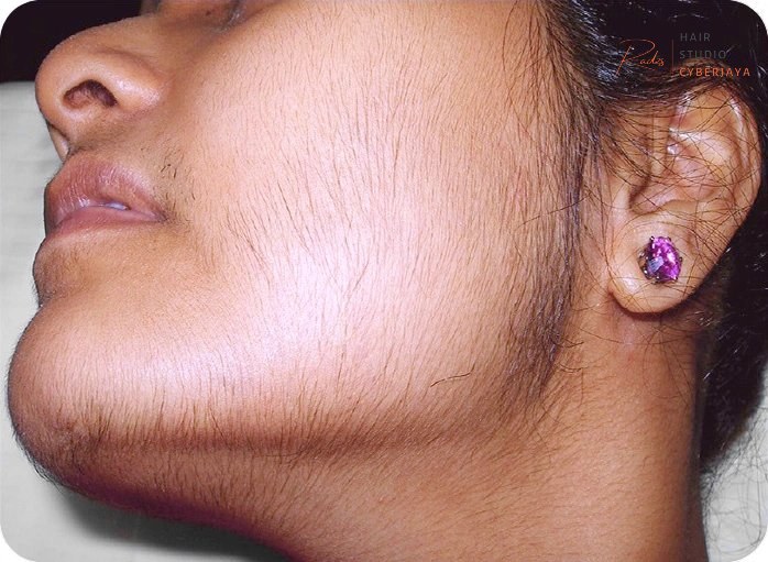 Permanent hair removal options for women with PCOS Understanding polycystic ovaries facial hair and permanent hair removal options